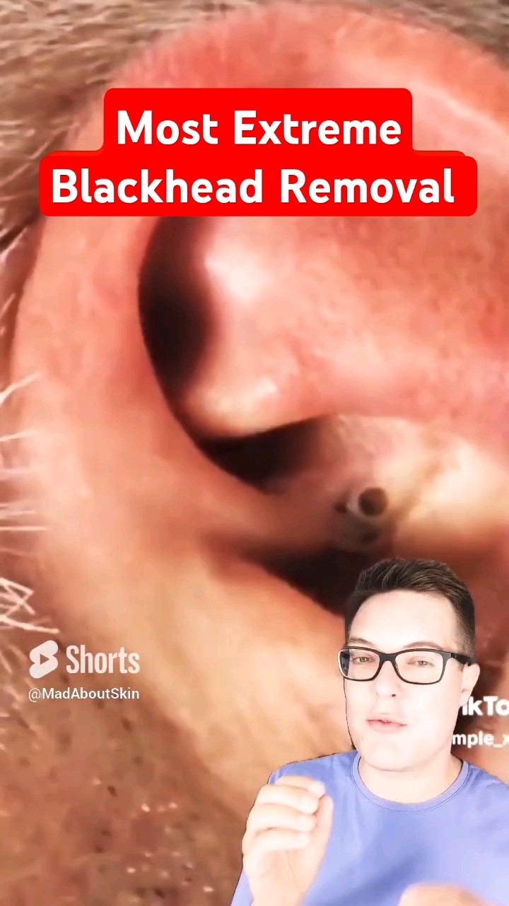 Most Extreme BLACKHEAD REMOVAL – Major Ear Blackhead Popping #shorts – YouTube