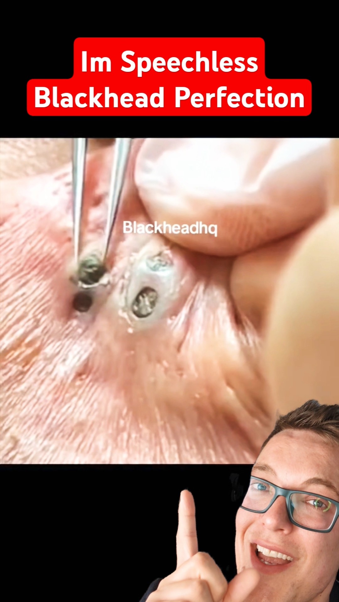 Crazy 3 In 1 Blackhead – ULTIMATE BLACKHEAD REMOVAL 2024 #shorts – YouTube