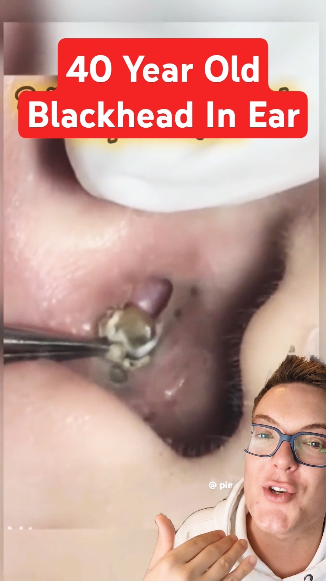 40 Year Old BLACKHEAD REMOVAL FROM EAR #shorts – YouTube