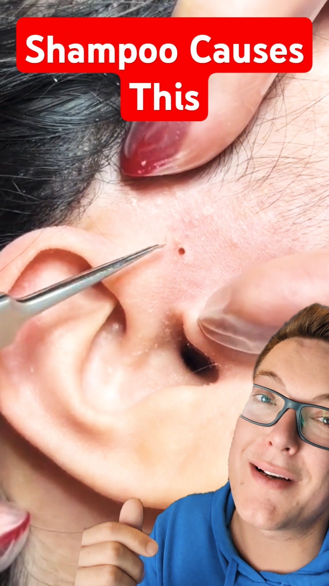 The Perfect BLACKHEAD REMOVAL #shorts – YouTube