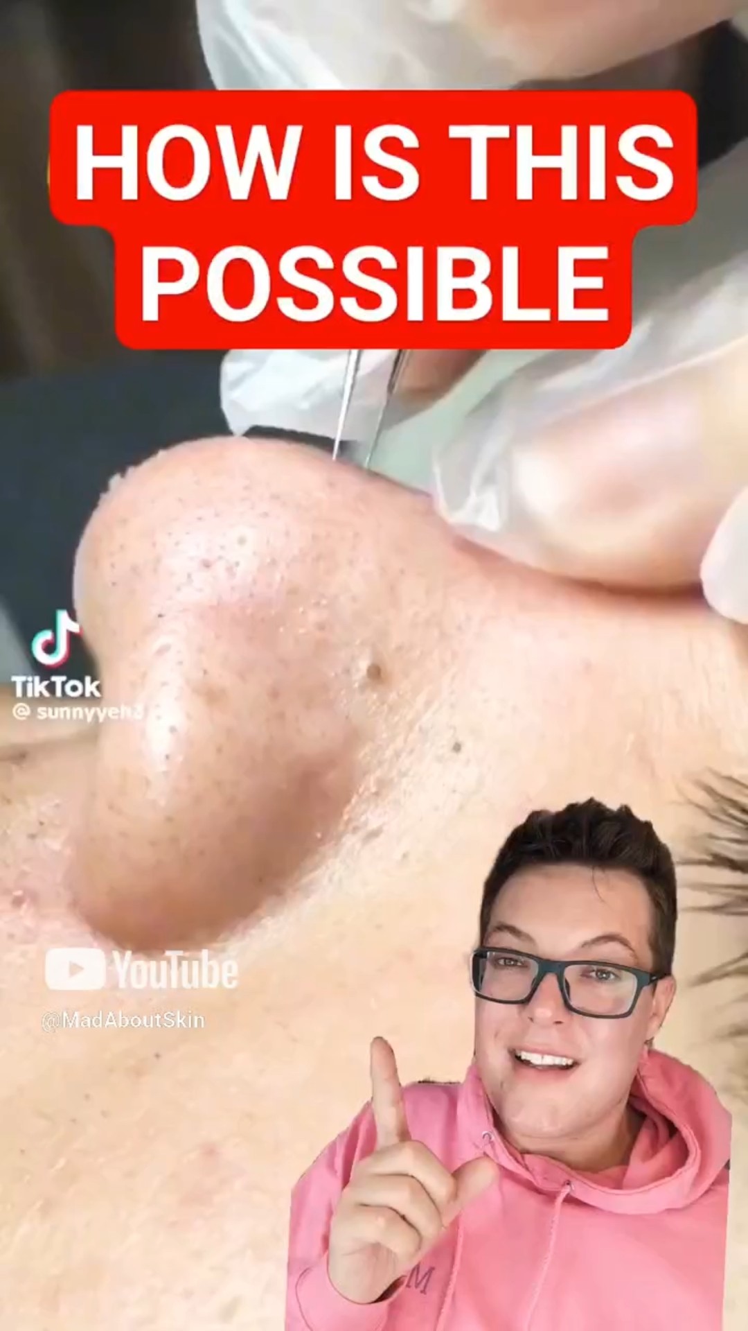 Perfect BLACKHEAD REMOVAL – This Is Crazy Satisfying #shorts – YouTube