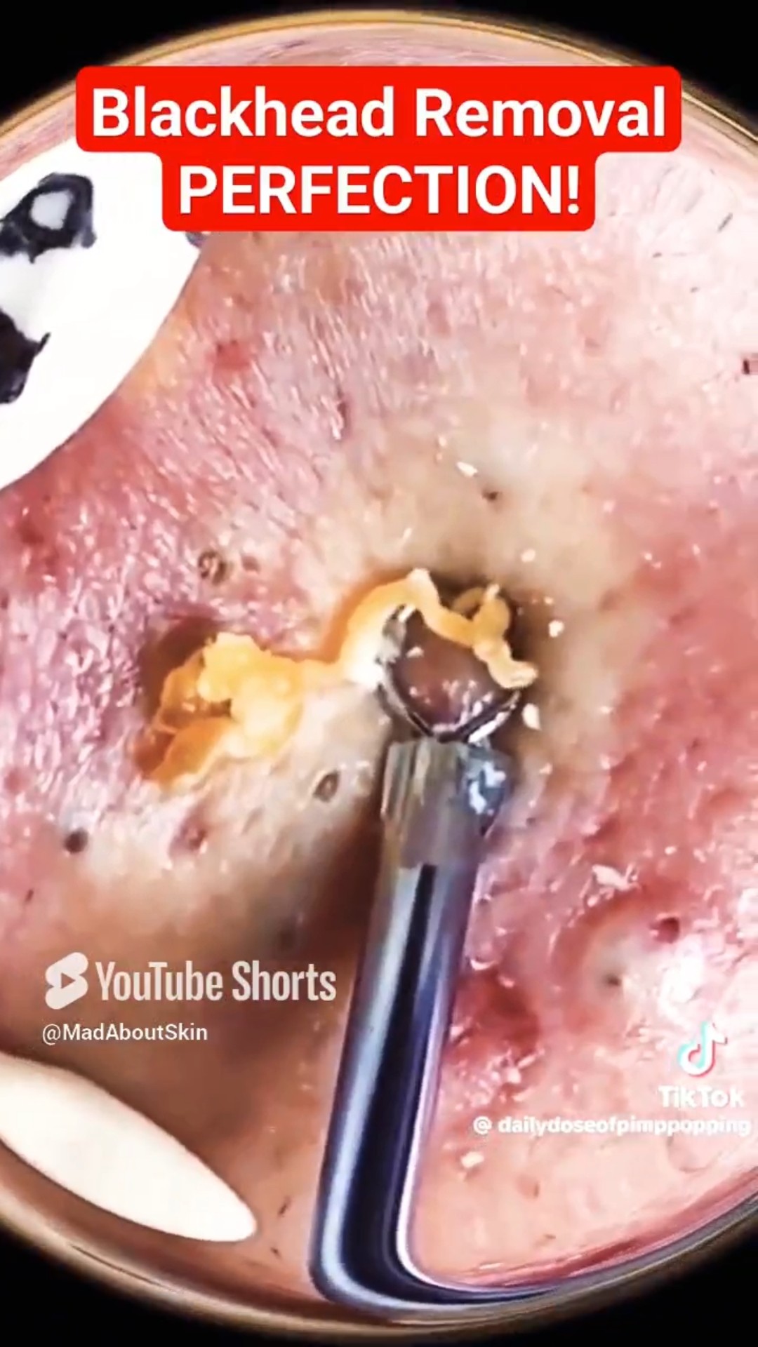 Rare BLACKHEAD REMOVAL – Perfect Blackheads Removal! #shorts – YouTube