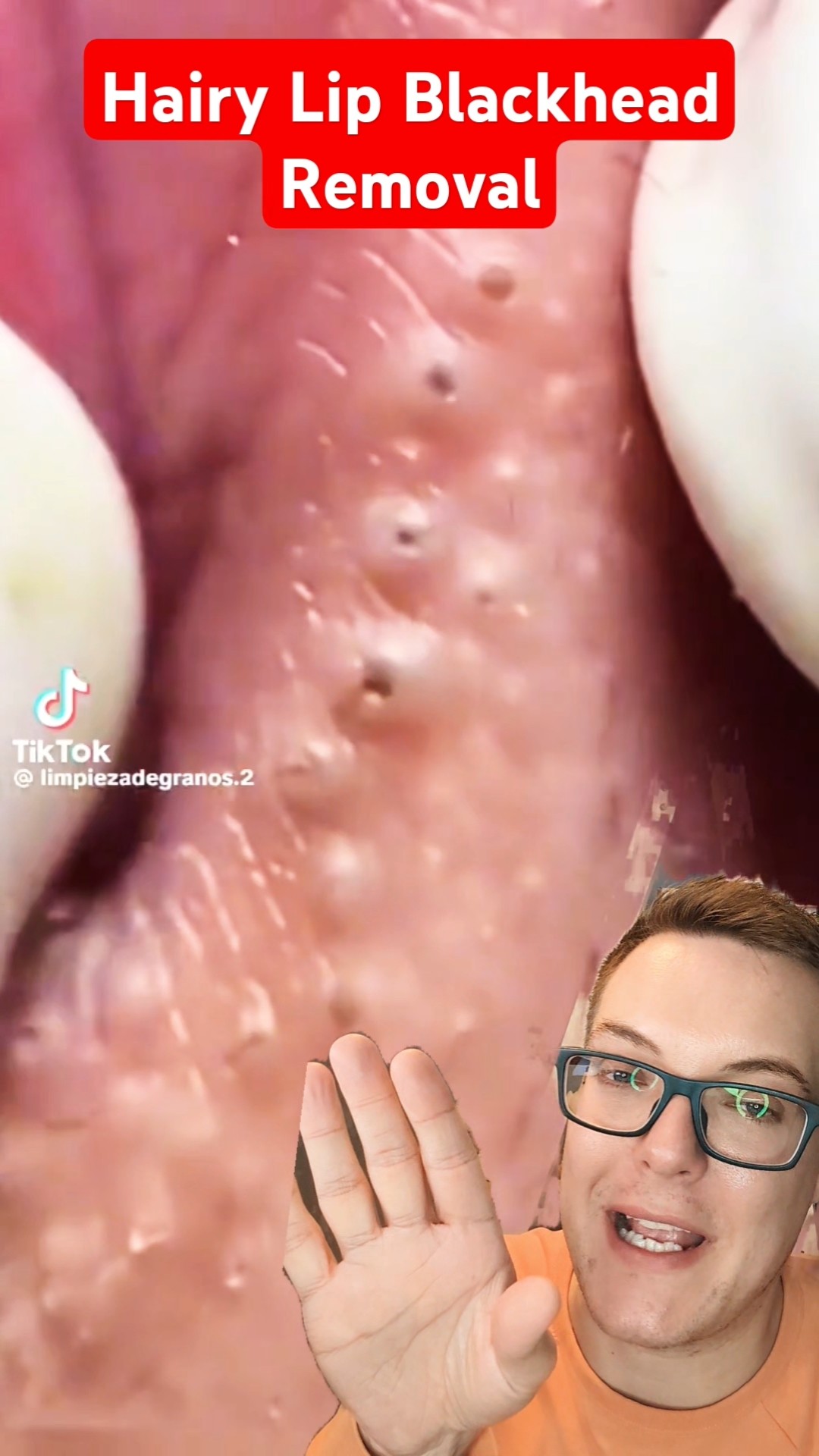 Crazy Hairy LIP BLACKHEAD REMOVAL #shorts – YouTube