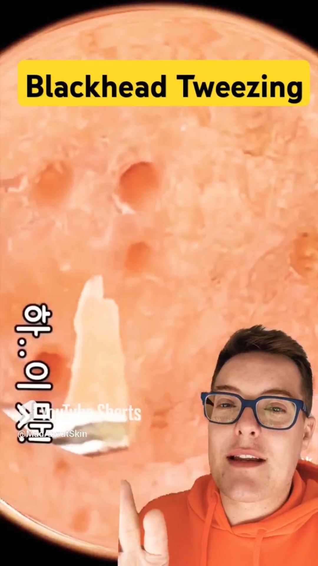 Controversial BLACKHEAD PLUCKING – Is This Blackhead Removal Wrong #shorts – YouTube