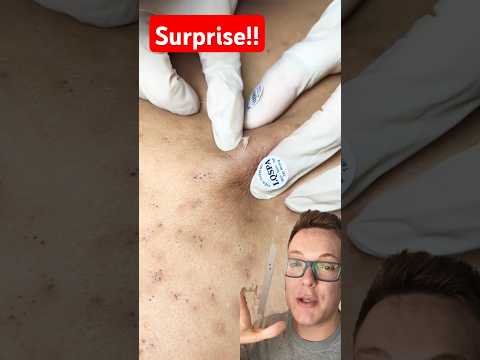 (Shocking) BLACKHEAD REMOVAL – Wait For It To Explode #shorts – YouTube