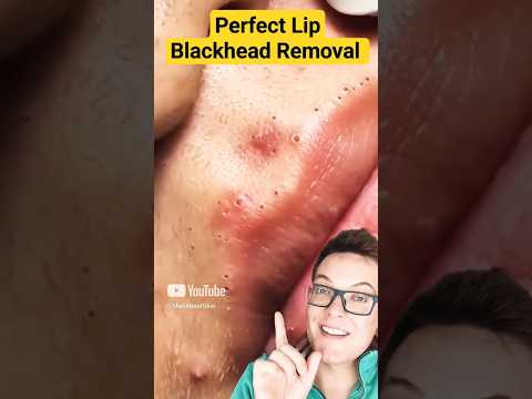 Worlds Best LIP BLACKHEAD REMOVAL #shorts – YouTube
