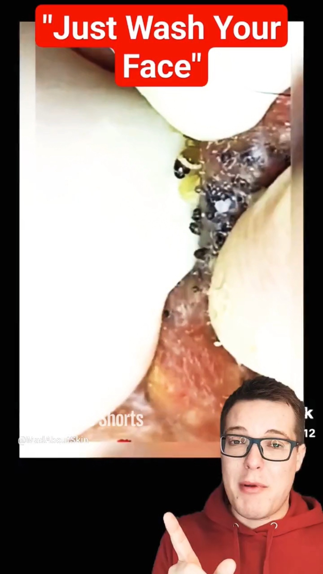 How Is This Possible – EXTREME BLACKHEAD REMOVAL #shorts – YouTube