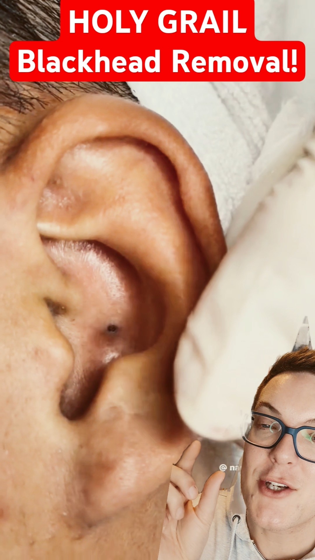 Perfection – The Ultimate EAR BLACKHEAD REMOVAL #shorts – YouTube