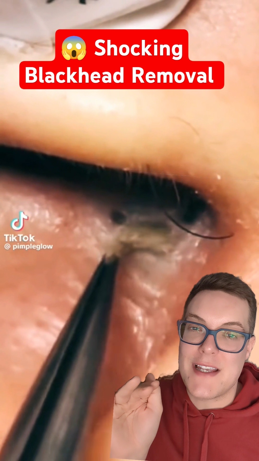 Shocking BLACKHEAD REMOVAL – Blackhead Inside Nose!! #shorts – YouTube