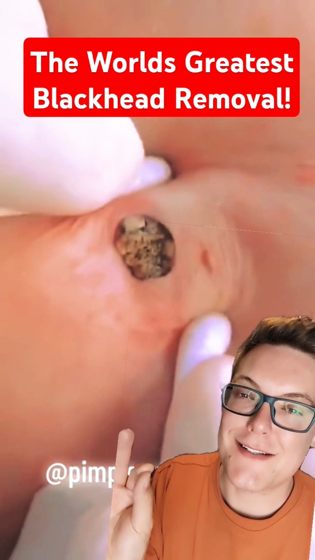 Greatest Ever BLACKHEAD REMOVAL – Super Huge Blackhead #shorts – YouTube