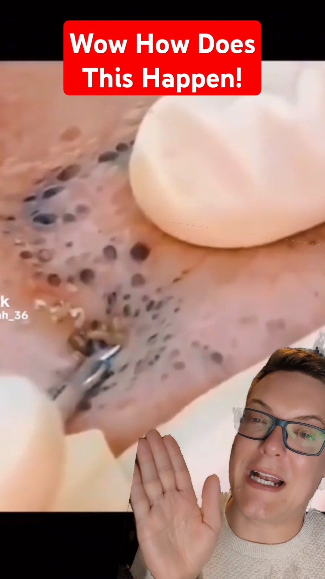 Huge Cluster BLACKHEAD REMOVAL – Solar Comedones #shorts – YouTube