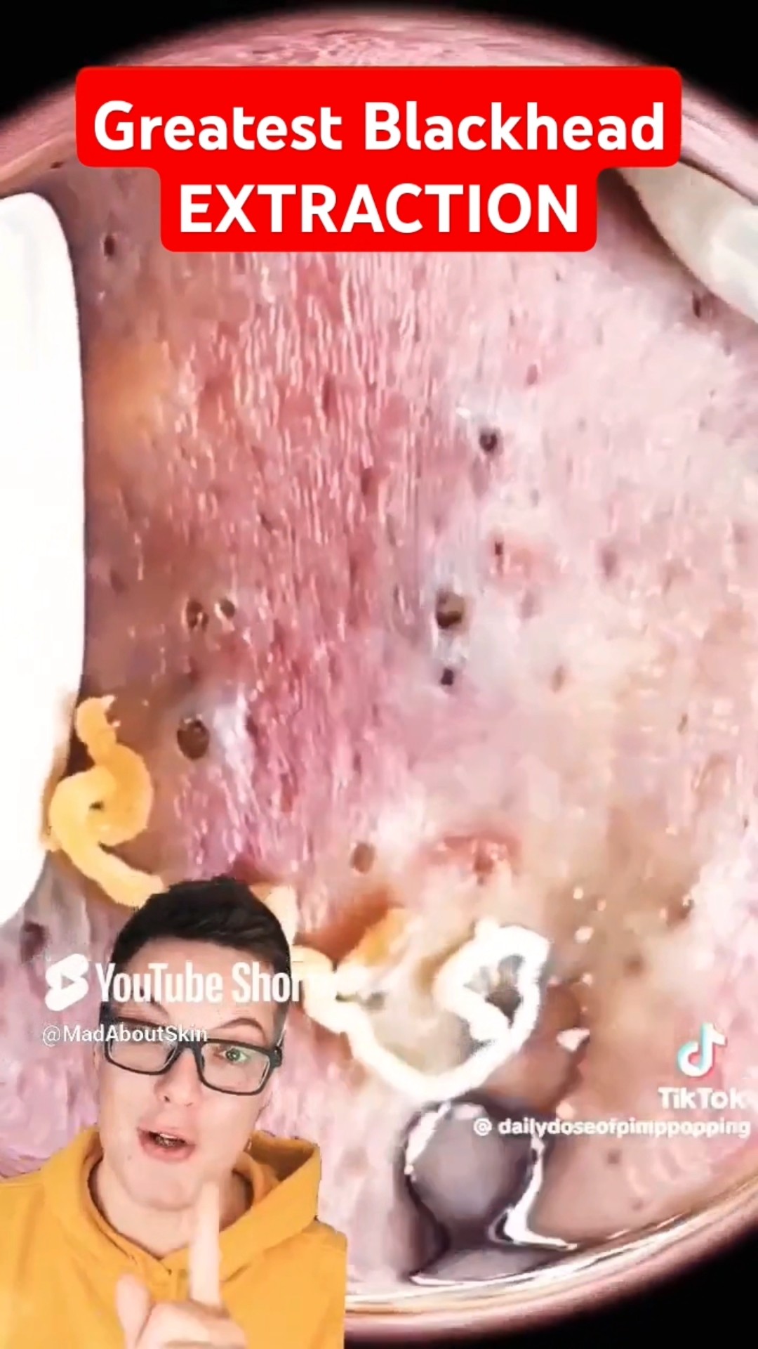 2025 GREATEST BLACKHEAD REMOVAL #shorts – YouTube